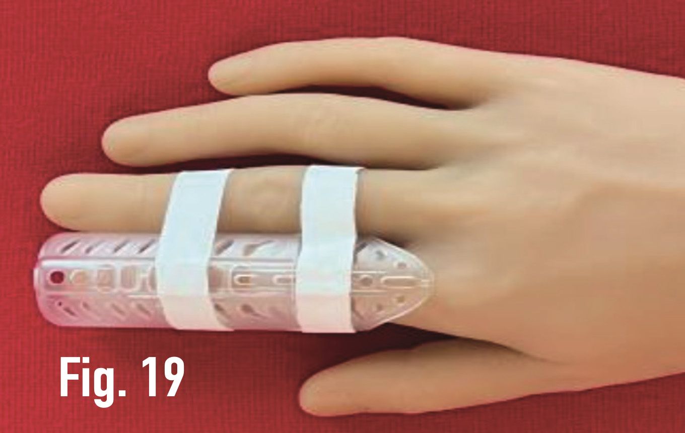 Hand with a DigiTube clear plastic finger splint strapped onto two fingers against a red background.