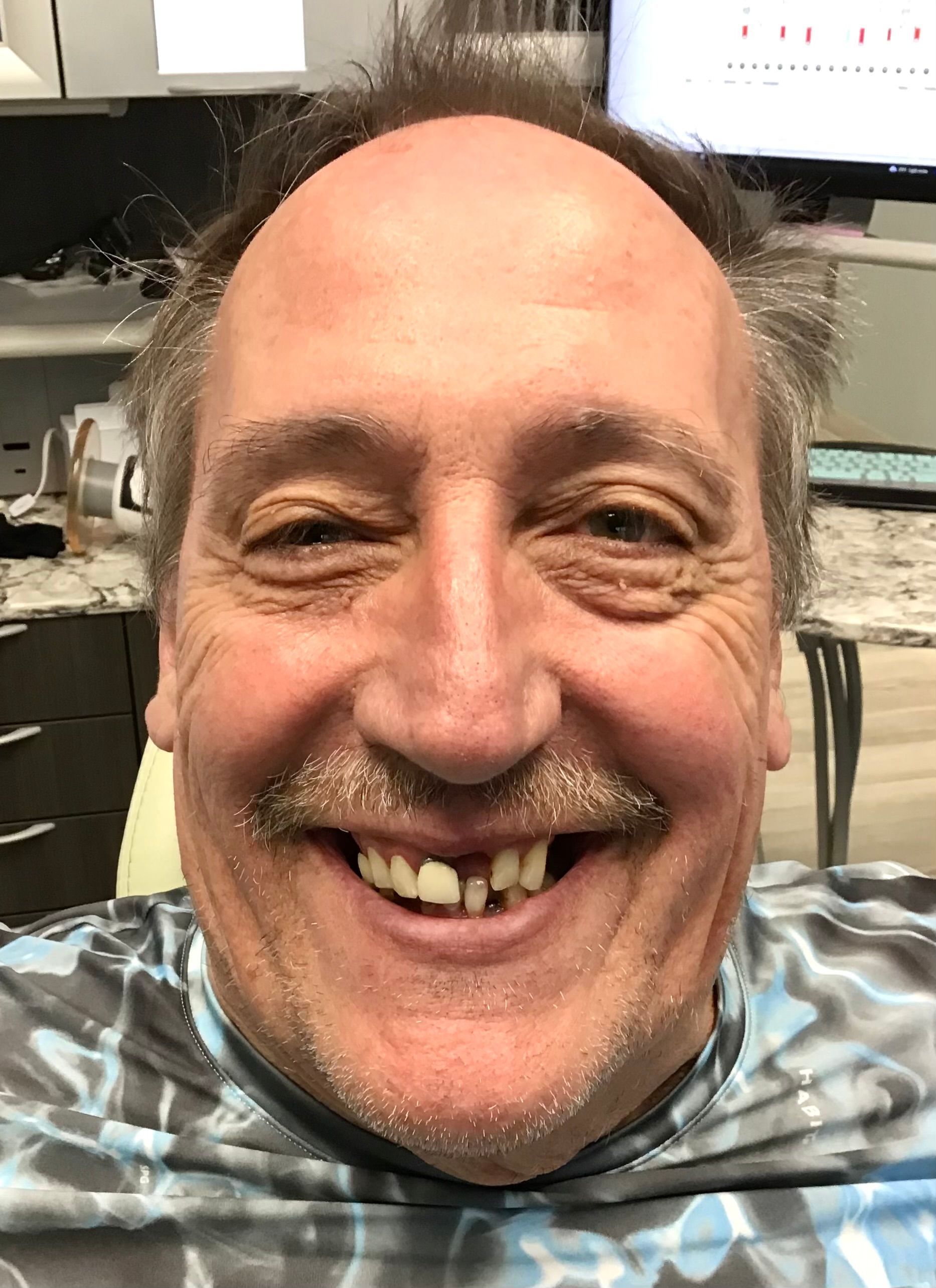 Mono Implant Case 10 Before