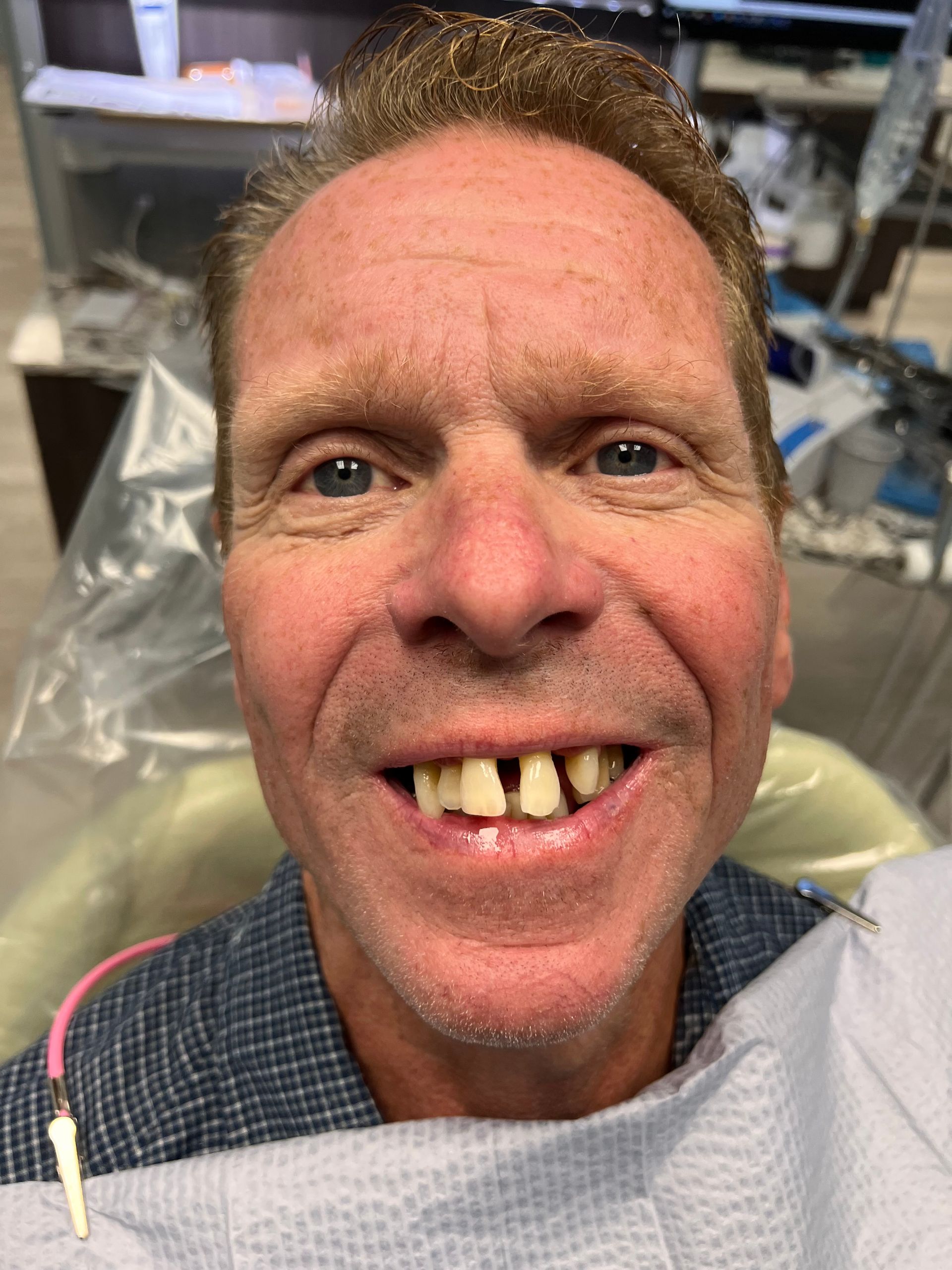 Mono Implant Case 9 Before