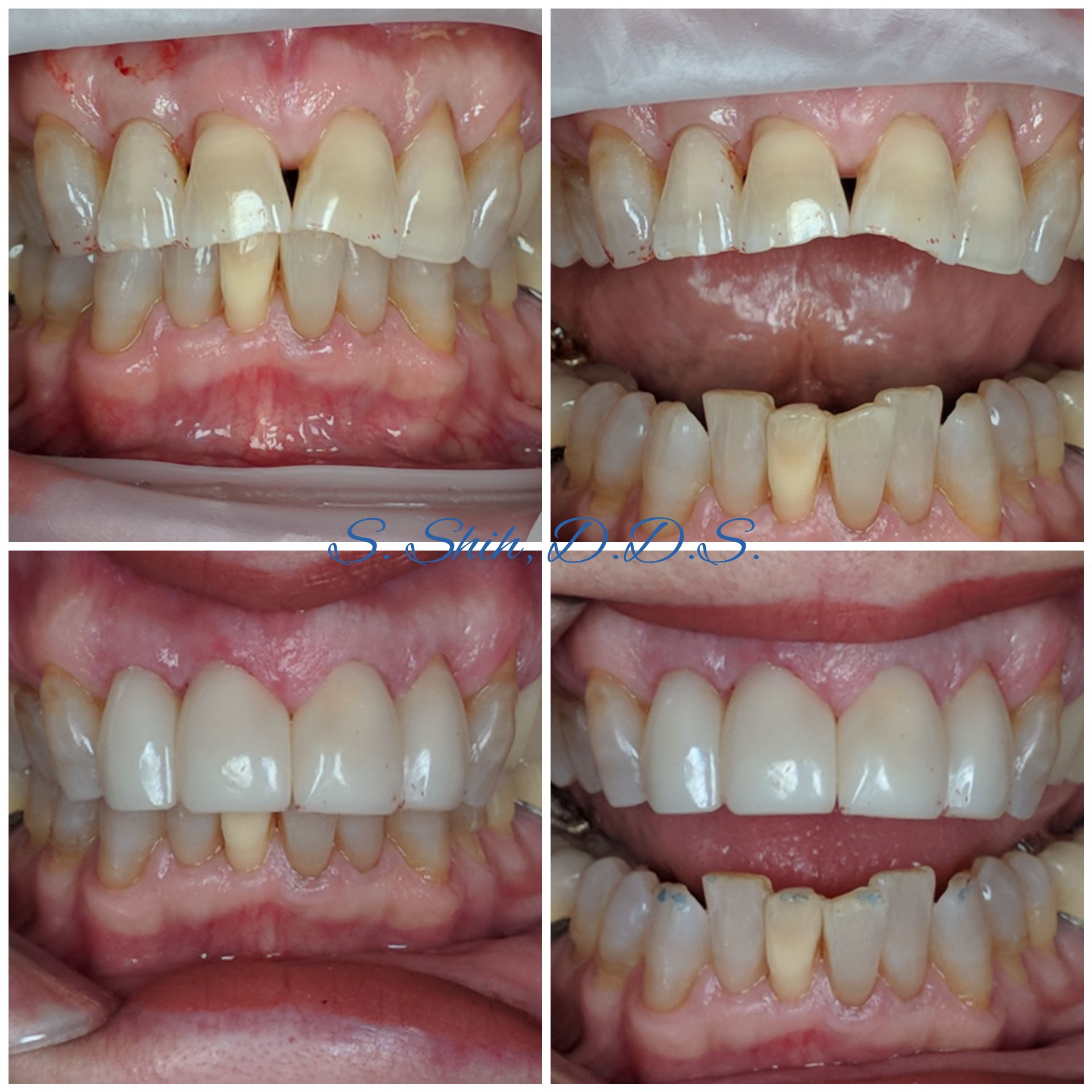 Chipped teeth