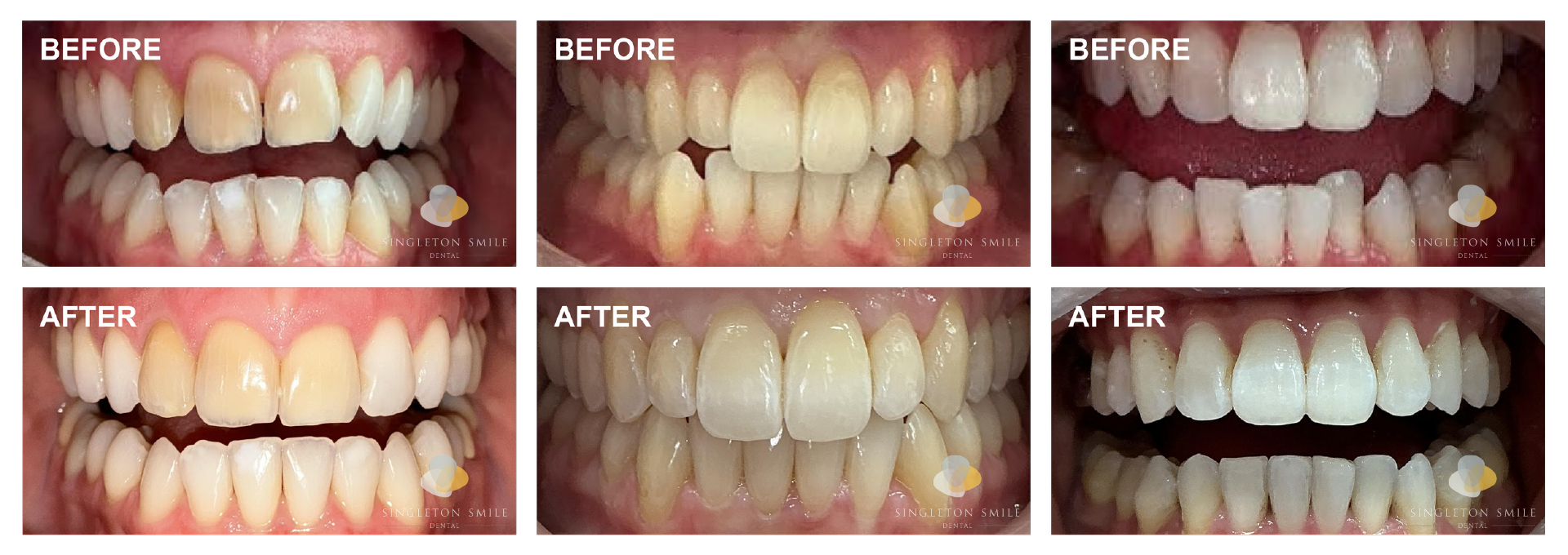 Before and After 1