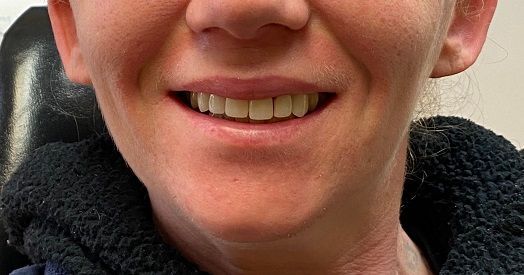 Straight, white smile