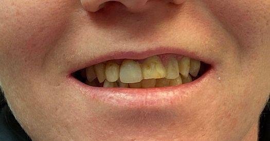 Crooked, discolored teeth