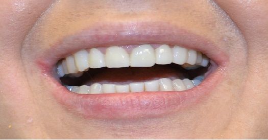 Close-up of a smiling mouth showing white teeth and pink lips