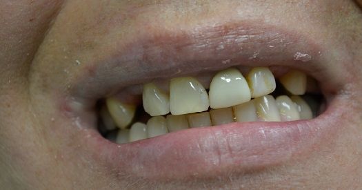Close-up of a mouth showing crooked, discolored teeth
