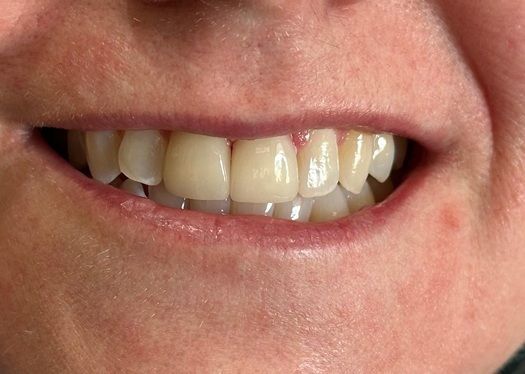 Crowns on upper front teeth