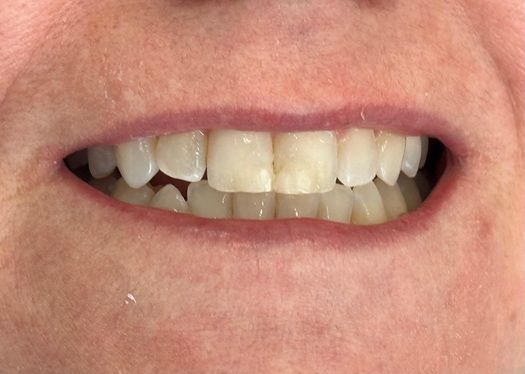 Uneven, yellowed front teeth