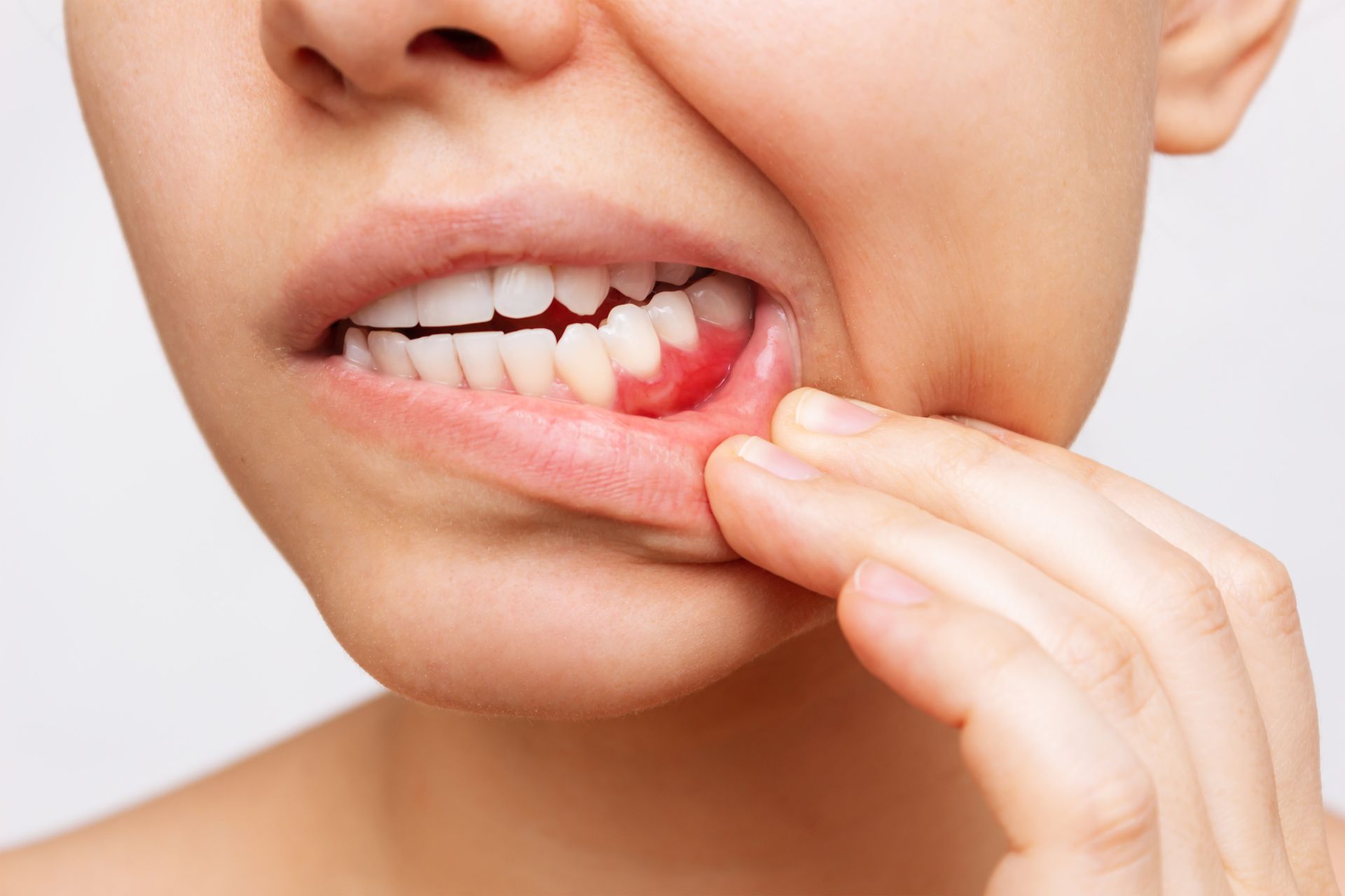Woman Holding Lip, Suffering From Gingivitis