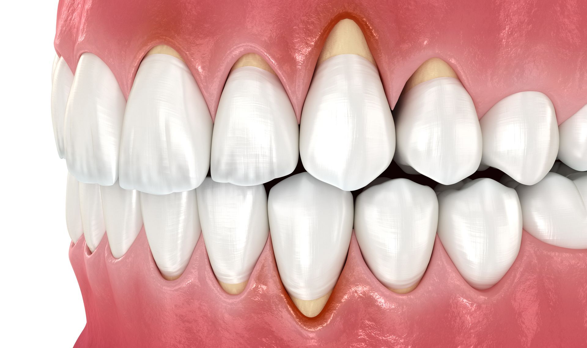 Image Displaying the Signs of Gum Disease