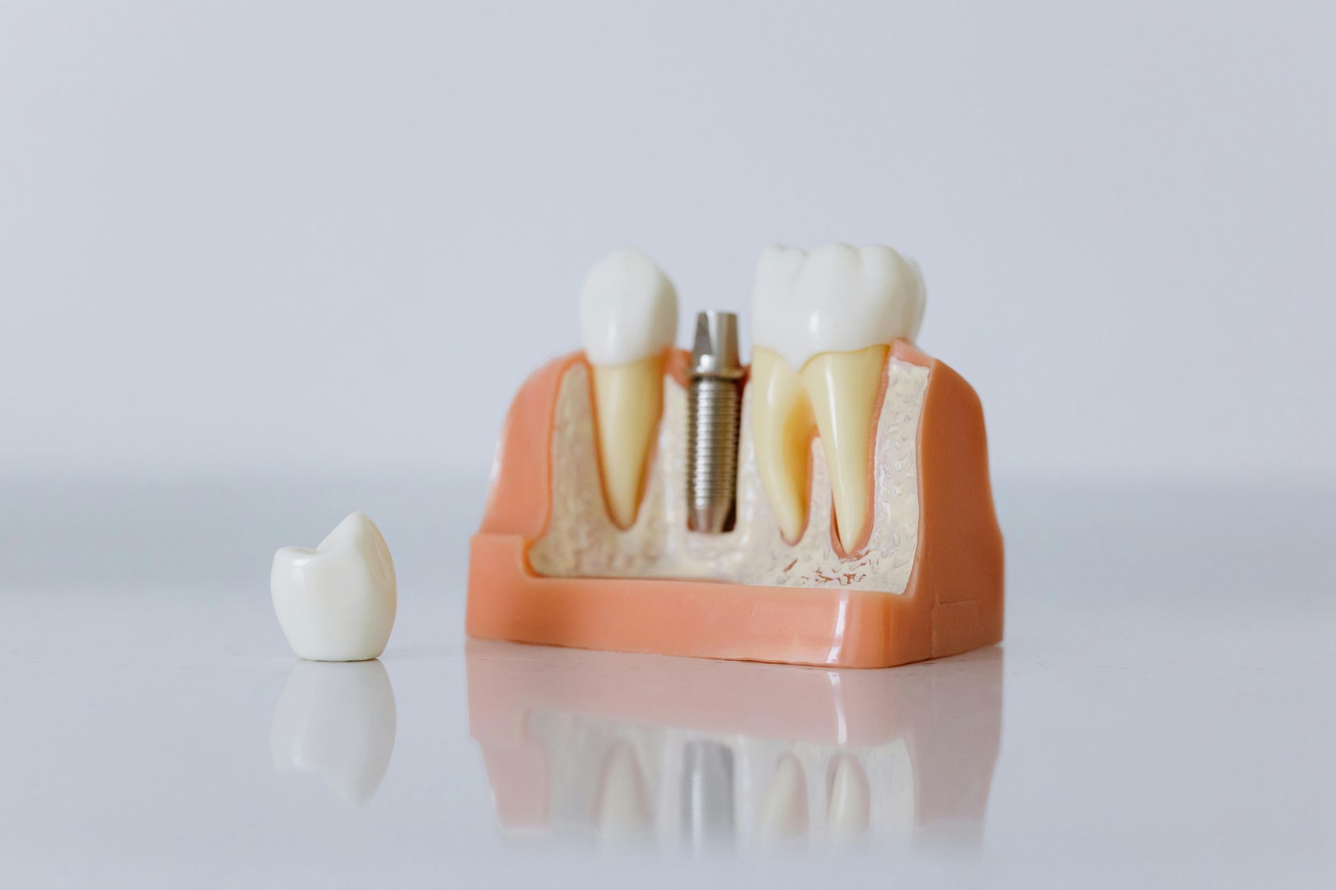 dental implants for Abilene, TX & the surrounding area