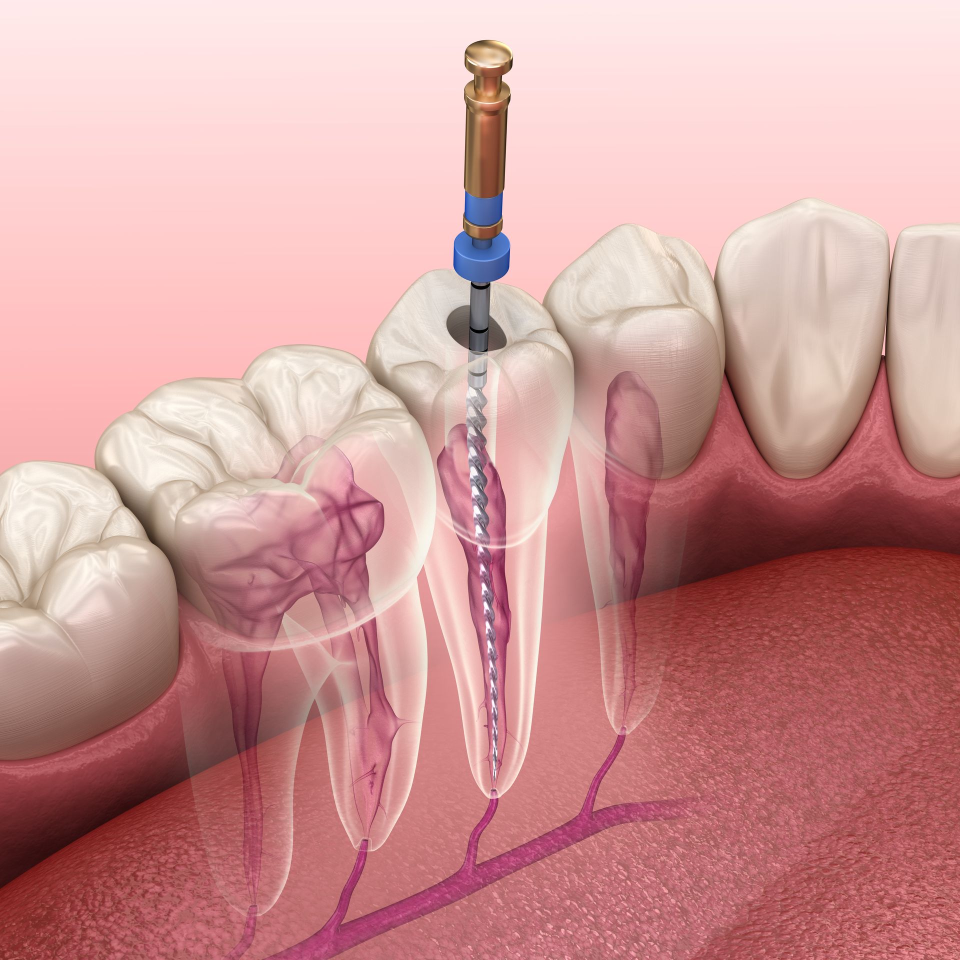 Dental root canal treatment illustration with endodontic file inside a tooth root.