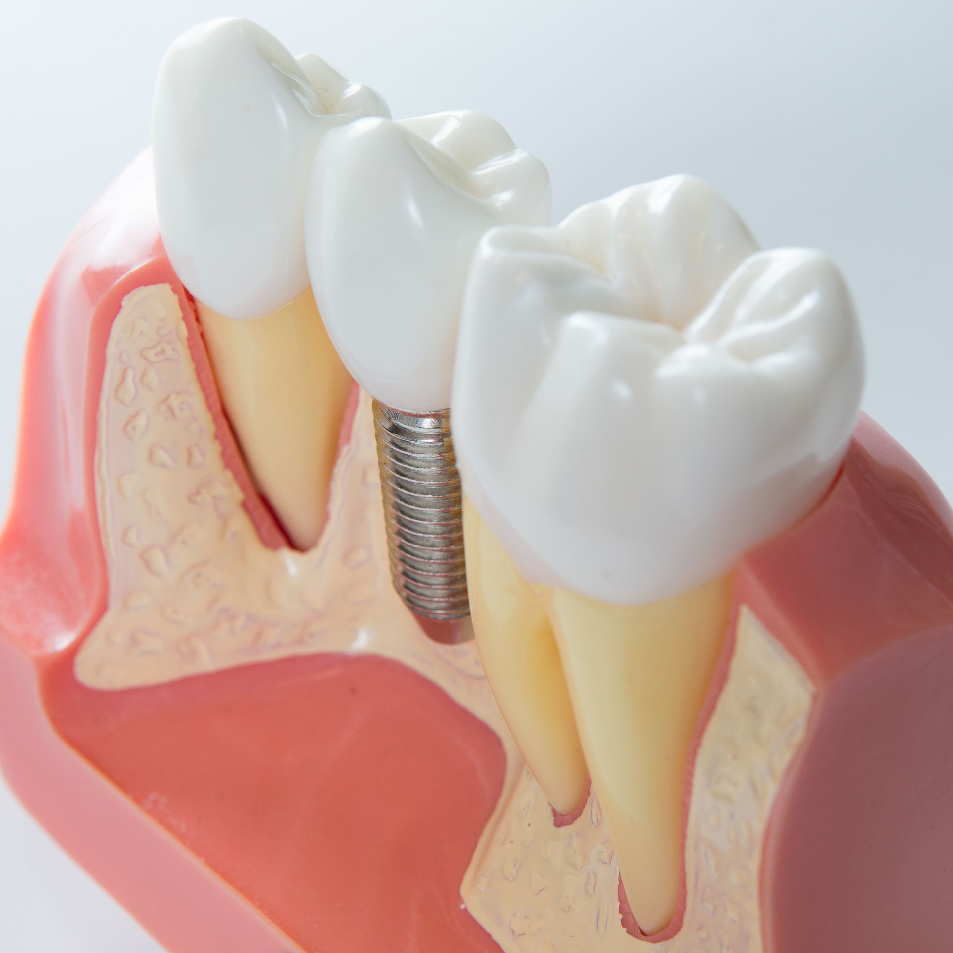 Dental implant between two white teeth in pink gums, showing a metal screw replacing a missing tooth.