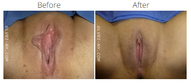 A side-by-side comparison of a vulva before and after a cosmetic procedure.