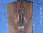 Close-up of human perineum, showing vulva and anus, with surrounding skin visible, set on a blue background.