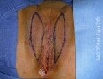 Surgical markings on a person's vulva, outlined in black, before a labiaplasty.