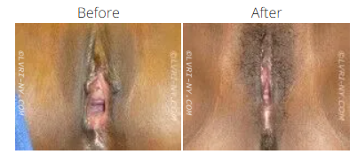 Medical comparison of a vulva before and after a procedure. The