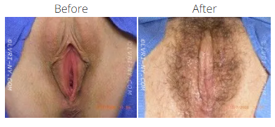 Comparison of a vulva before and after hair removal.