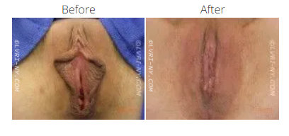 Before and after photos of a vulva, showing a change in size and shape after a procedure.