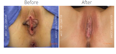 Comparison of a vulva before and after labiaplasty surgery.