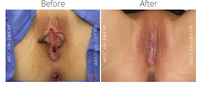 Before and after images of a vulva, the