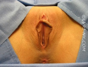 Close-up of a vulva, viewed from above, surrounded by skin and blue fabric.