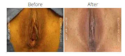 Comparison of a before and after view of a vulva. Before has dark hue. After has lighter skin tone.