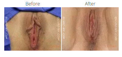 Comparison of a vulva before and after a procedure.
