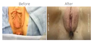 Comparison of a vulva before and after a procedure, showing changes in appearance.