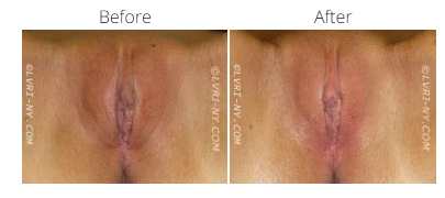Comparison of a before and after view of a vulva. 