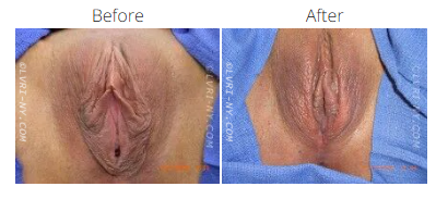 Comparison of a vulva before and after a medical procedure. Skin tones vary.