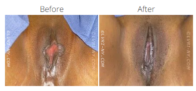 Before and after view of a vulva. The before image shows a protruding area, and the after image appears smoother.