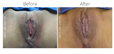 Comparison of vulva