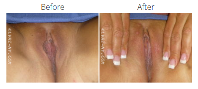 Comparison of a vulva before and after a surgical procedure, with hands holding the labia open in the