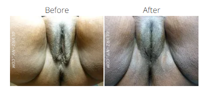 Comparison of a person's vulva