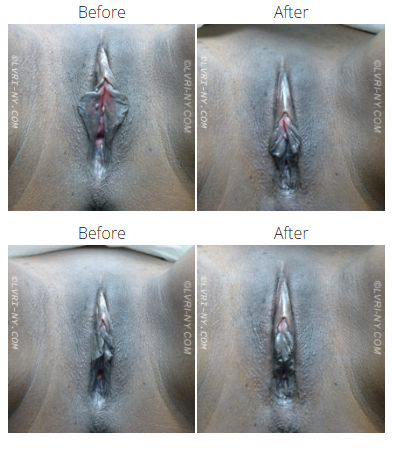 Four comparison images showing a vulva 