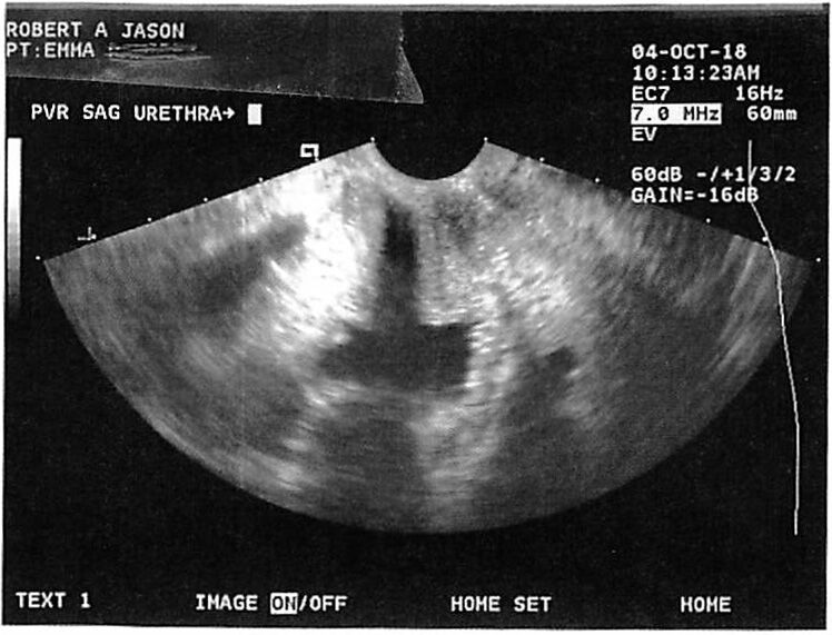 Ultrasound scan of the urethra, showing internal structures. Text data is overlaid on the image.