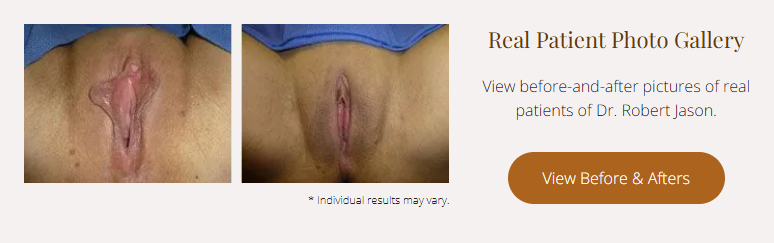 Before and after photos of a vulva, showcasing the results of cosmetic surgery.