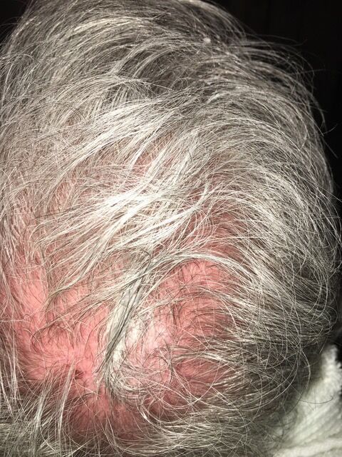 Scalp with thinning, gray hair and areas of red skin.