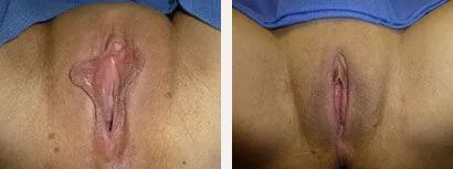 Two vulva images, one pre-surgery with swollen tissue and one post-surgery, showing reduced size.