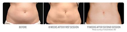 Before and after photos of a midsection, showing fat reduction after sessions.