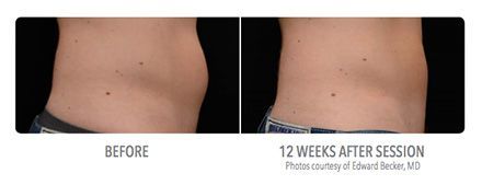 Side-by-side comparison of a torso before and 12 weeks after a session, showing reduced fat on the abdomen.