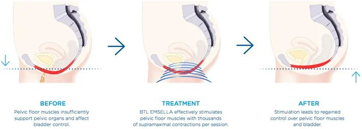 Diagram showing pelvic floor muscle treatment. Before: weak muscles. Treatment: stimulation. After: muscles restored.