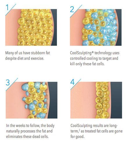 Diagram illustrating CoolSculpting fat reduction: fat cells are cooled, processed, and eliminated.