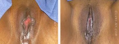 Two images of a vulva, before and after a procedure.