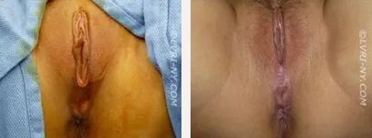 Two images: Before and after vulvoplasty. Shows surgical area, different in color and appearance.