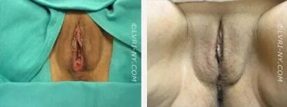 Two views of a vulva, one in green surgical drape, the other nude.