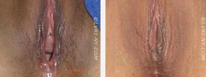 Comparison of a vulva before and after a procedure. The left shows a larger opening, the right shows a smaller one.