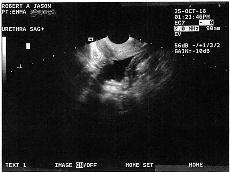 Ultrasound scan of the urethra, displaying a cross-sectional view of the anatomy.