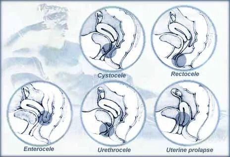 Diagram of pelvic organ prolapse, showing cystocele, rectocele, enterocele, urethrocele, and uterine prolapse.