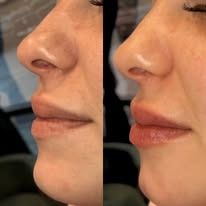 Side-by-side close-up profile of a nose and lips, showing a before-and-after cosmetic change